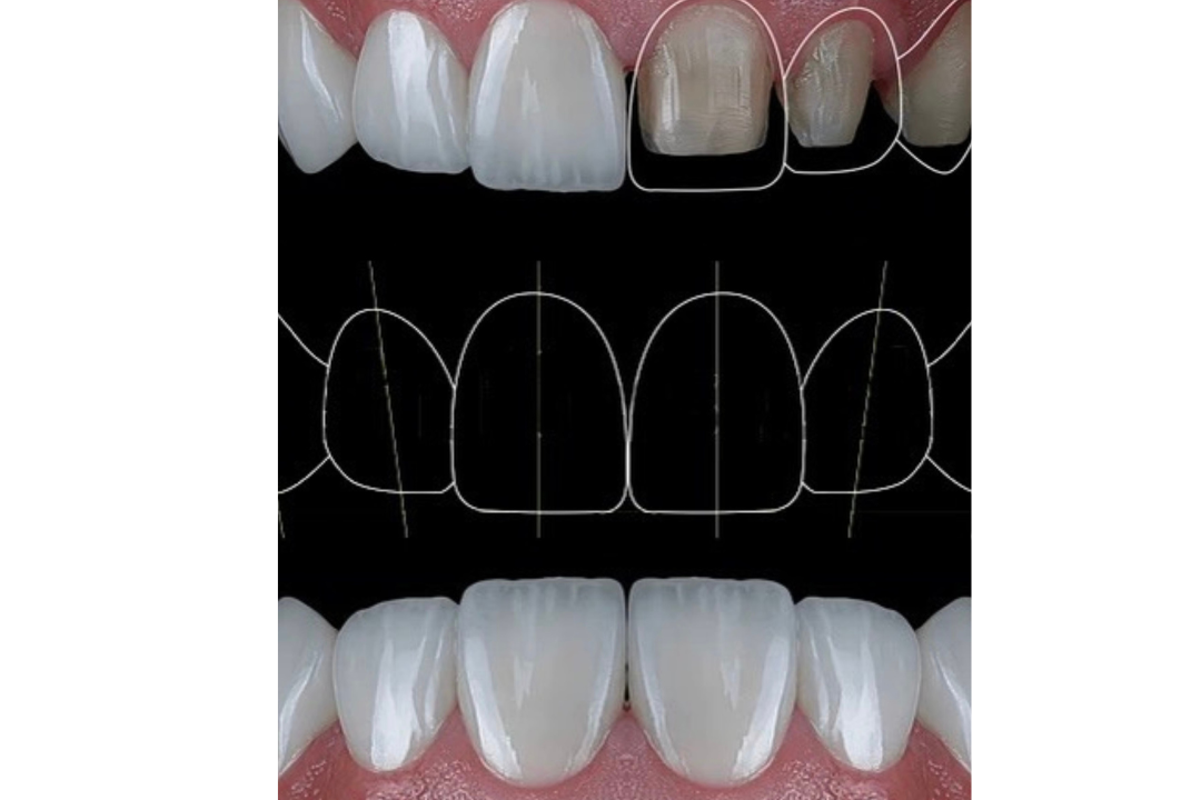 Smile Makeover & Digital Smile Design | Blue Dental Chennai